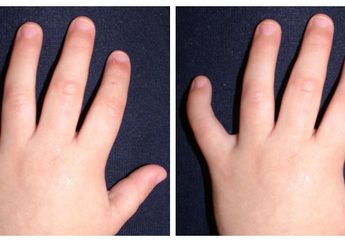 Jari Telunjukmu Lebih Pendek dari Jari Manismu? Itu Tandanya Kamu Egois