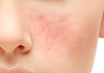 Atasi Kemerahan, Bengkak dan Gatal pada Kulit Wajah dengan 5 Bahan Ini