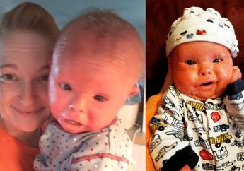 Bayinya Derita Penyakit Kulit Langka, Sang Ibu Justru Memandikannya Pakai Cairan Pemutih Pakaian