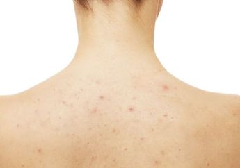 Jerawat di Punggung Bikin Nggak Pede? Yuk Atasi Pakai 4 Bahan Dapur Ini