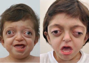 Mengidap Sindrom Crouzon, Pasca Operasi Wajah Anak Ini Mengagumkan Banget
