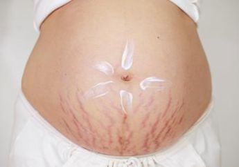 Lakukan 4 Perawatan Kulit Ini untuk Hilangkan Stretch Marks Setelah Melahirkan!