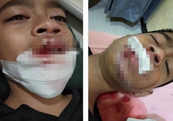 Tak Sengaja Bakar Botol Pengharum Ruangan, Seorang Bocah Alami Nasib Sial