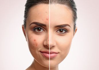 Rekomendasi Produk Salep untuk Menghilangkan Bekas Jerawat yang Kehitaman