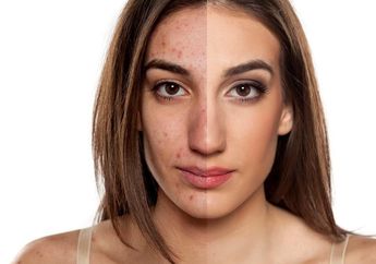 Menghilangkan Bekas Jerawat Hanya dengan 3 Langkah, Cobain Yuk!