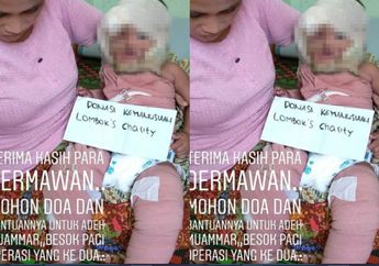 Kisah Muammar, Bocah 1 Tahun yang Alami Luka Bakar Hingga 70 % Akibat Ledakan Spiritus