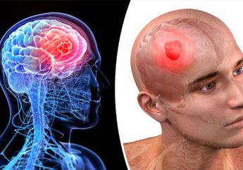 5 Gejala Kanker Otak, Penyakit yang Diderita Putra Marcella Zalianty