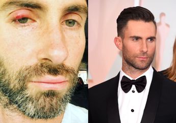 Adam Levine Bintitan, Simak 4 Cara Alami yang Bisa Mengatasinya