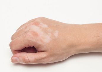 Ini Alasan Wanita Usia 40an Lebih Banyak Memiliki Bintik Putih di Kulitnya