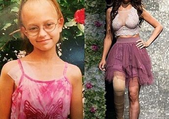 Derita Kanker Tulang, Perempuan Ini Jadi Model Cantik Tanpa Kaki