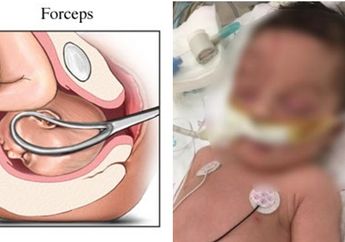 Gunakan Metode Forsep Saat Persalinan, Kepala Bayi ini Sampai Terputus