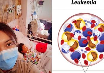 8 Ciri Orang yang Rentan Terkena Leukimia, Kanker Darah yang Diderita Shakira Aurum, Putri Denada