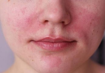Jangan Diabaikan! Ini Dia 5 Kandungan Skincare yang Dapat Memperburuk Kulit Rosacea, Apa Saja?