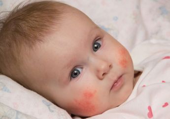 4 Masalah Kulit yang Sering Menyerang Bayi dan Cara Menanganinya