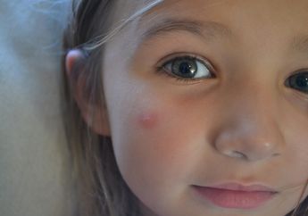 Tutupi Bekas Gigitan Nyamuk di Wajah dengan 5 Langkah Makeup Ini!