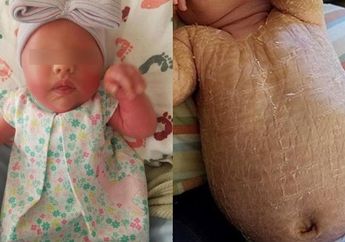 Kulit Balita ini Menebal Bak Kulit Ular, Ternyata ini Penyebabnya