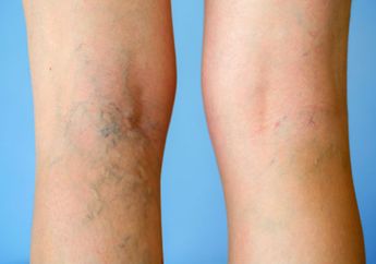 Intip yuk Cara Atasi Varises, Salah Satunya Gunakan Alat Makeup loh