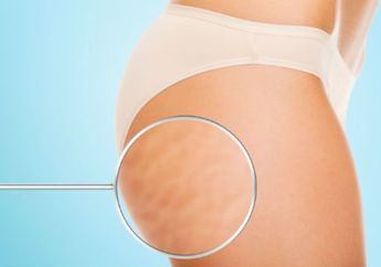 Cara Menghilangkan Selulit yang Ampuh Menurut Ahli Dermatologi, Cobain Yuk!