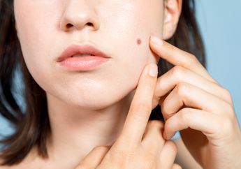 Mengobati Masalah Kulit Berjerawat dengan Perawatan Alami Shea Butter