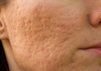 Modalnya Cuman Bahan Dapur yang Murah Meriah Ini, Pori-pori Besar di Wajah Bisa Teratasi, Berani Coba?