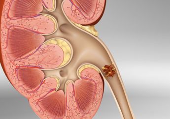 Makanan Ini Boleh Dimakan dan Harus Dihindari Penderita Batu Ginjal, Salah Satunya Protein Hewani