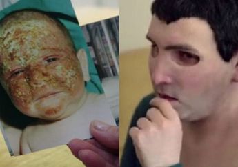 Seumur Hidupnya Ia Harus Kenakan Topeng, Jika Tidak ini yang Terjadi