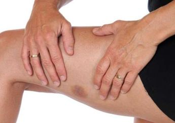 Sering Memar di Bagian Tubuh Tiba-tiba? Begini loh Penyebab dan Mengatasinya