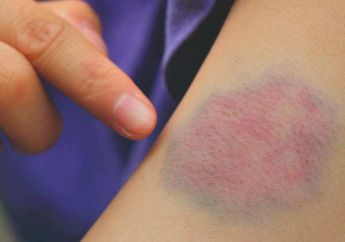 Waspadai Kram Kaki dan 3 Gejala yang Tunjukkan Pembekuan Darah Berikut