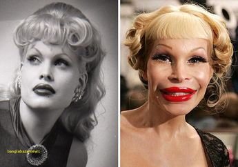 Padahal Aslinya Sudah Cantik dan Ganteng, Tapi Operasi Plastik Gagal Malah Bikin Wajah 5 Orang Ini Jadi Mengerikan