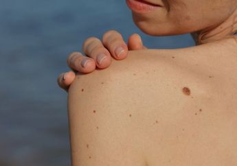 Apa yang Sebabkan Tanda Lahir di Kulit? Kenali Beberapa Jenisnya, Nggak Cuma 1 nih!
