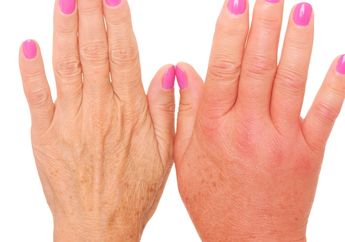 Apa sih Penyebab Jari Membengkak? Kepoin yuk, Salah Satunya Penyakit Serius nih!