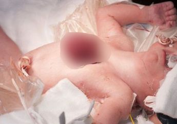 Perjuangan Vanellope Bayi dengan Jantung di Luar Tubuh, Begini Kondisinya Sekarang