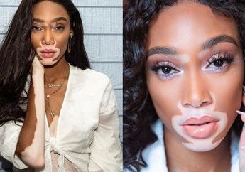 Winnie Harlow Dibully Karena Kelainan Kulit, Kini Jadi Model Victoria Secret