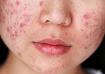 4 Langkah Perawatan Wajah untuk Kulit Berjerawat yang Tepat, Pakai Krim Jerawat Dulu Sebelum Pelembab!