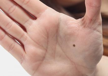 5 Bahan Alami untuk  Menghilangkan Tahi Lalat. Nggak Sakit Lho!