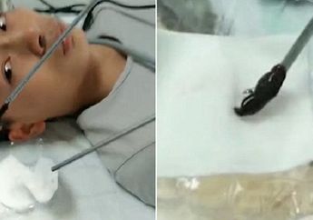 Seorang Pria Mimisan Sepuluh Hari Berturut-turut, Larva Hewan Pengisap Darah Ditemukan Hidup di Bulu Hidungnya