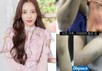 Eksklusif, Dispatch Rilis Foto-foto Memar di Tubuh Goo Hara Setelah Pertikaiannya dengan Sang Kekasih!
