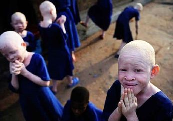Diculik Hingga Dibunuh, Tubuh Seorang Albino Afrika Diburu Untuk Sihir