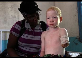 Menyedihkan! Orang Albino yang Berada di Afrika Justru Jadi Buruan dan Dihargai Senilai Rp1,1 Miliar