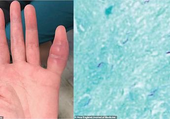 Langka! Infeksi Bakteri yang Biasa Ditemukan di Paru-Paru, Malah Bersarang di Jari Perempuan Ini