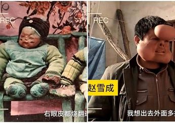 Alami Luka Serius di Wajah Saat Bayi, Perubahan Wajah Pria ini Bikin Haru