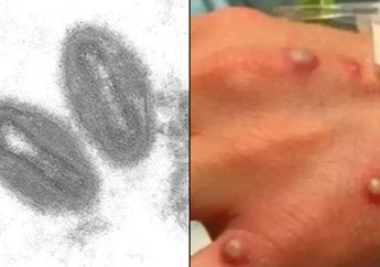 Virus Baru Monkeypox, Mirip Cacar Namun Mematikan, Sebarapa Parahkah?