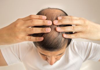 Garis Rambut di Sekitar Dahi Mundur, Tanda Anda Mengalami Kebotakan
