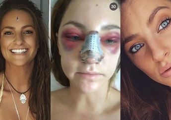 Deretan Transformasi Wajah Bengkak Usai Operasi Plastik, Ada dari Indonesia