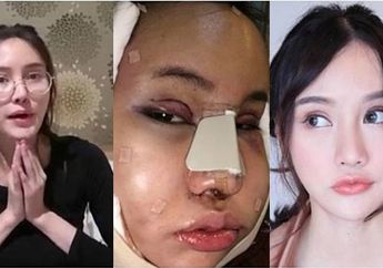 Warganet Duga Via Vallen Lakukan Operasi Plastik: Faktanya 'Oplas' Tak Seinstan yang Dibayangkan, Wajah Wanita Ini Bengkak 3 Bulan Setelah Jalani Operasi