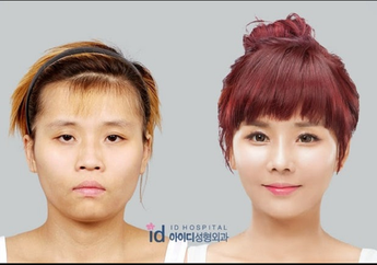 5 Foto Perubahan Drastis Sebelum dan Sesudah Operasi Plastik