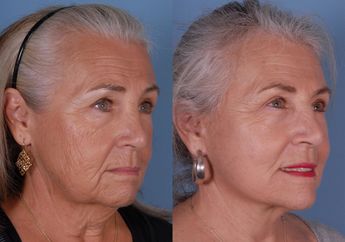 Prosedur Sedot Lemak di Usia Tua: Apakah Lazim Dilakukan?