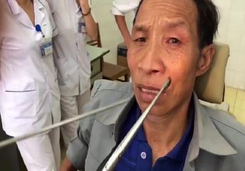 Seorang Pria Alami Mimisan, Setelah Diperiksa Dokter Ternyata Ada Parasit Bersarang di Hidungnya