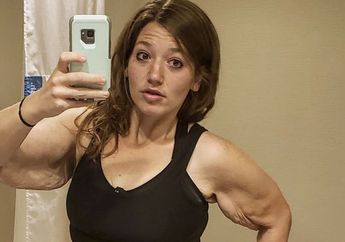 Berhasil Turunkan Berat Badan Sebanyak 141 Kg, Kulit Wanita Ini Menggantung Seberat 3 Kg