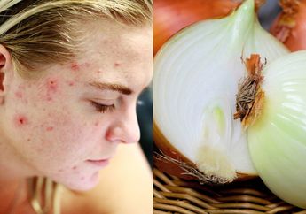 3 Tips Cara Menghilangkan Bekas Jerawat dengan Bahan Alami, Salah Satunya Gunakan Jus Bawang Bombay